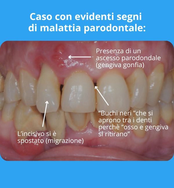 Caso con evidenti segni di malattia parodontale